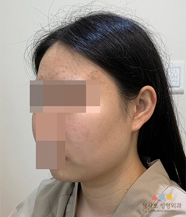 수술 전
