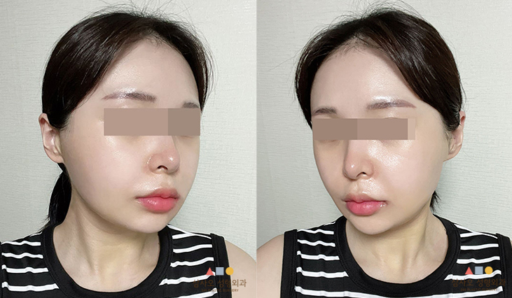 수술 후