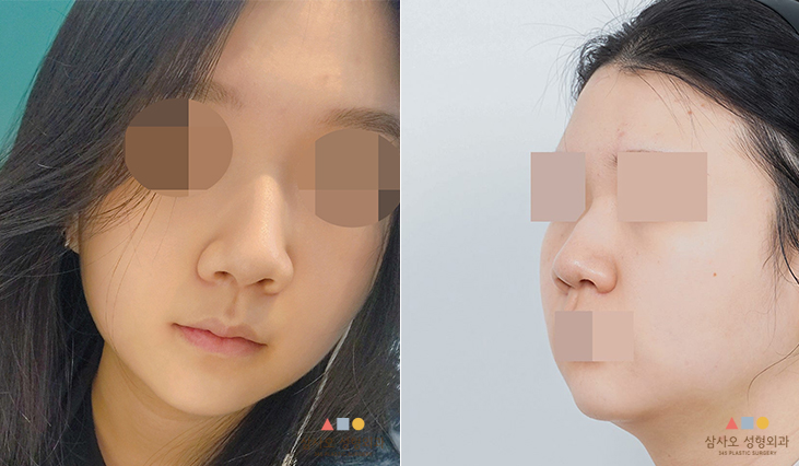 수술 전