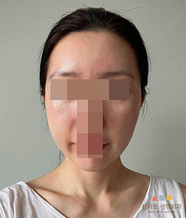 수술 후
