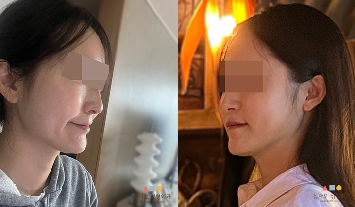 수술 전