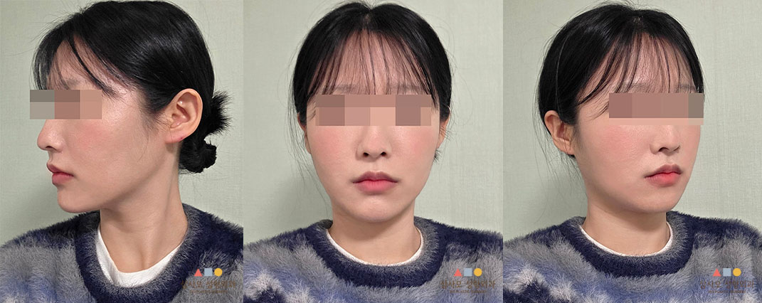 수술 후