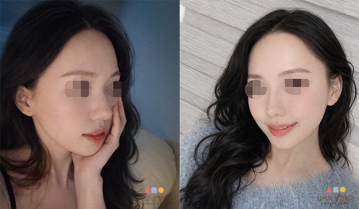 수술 후