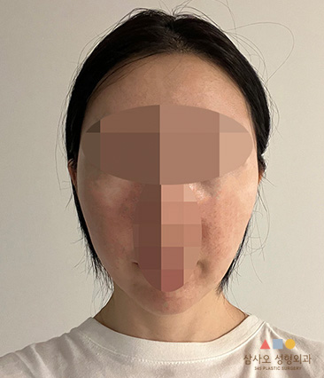 수술 후