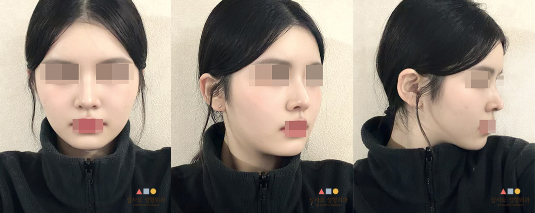 수술 후
