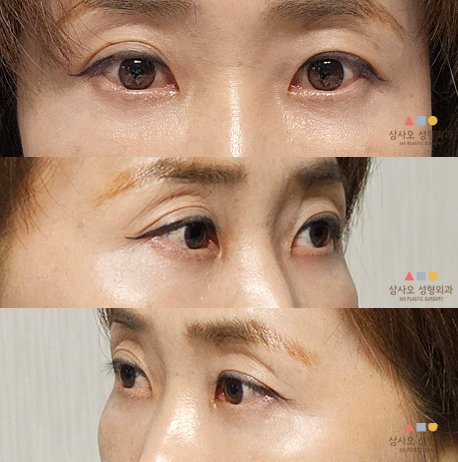 수술 후