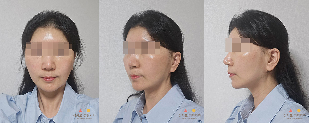 수술 후