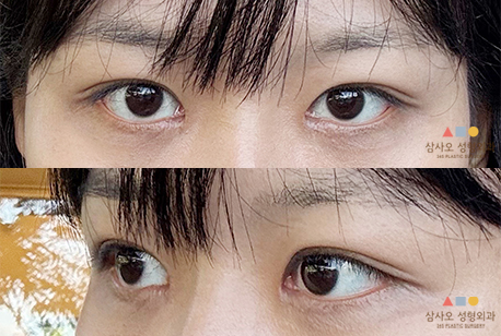 수술 후