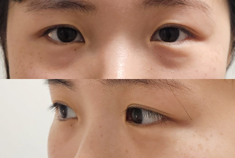 수술 전