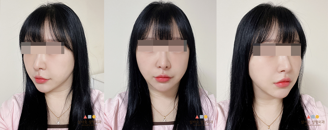 수술 후