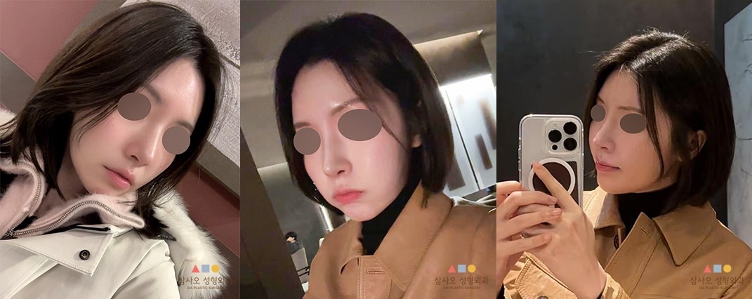 수술 후