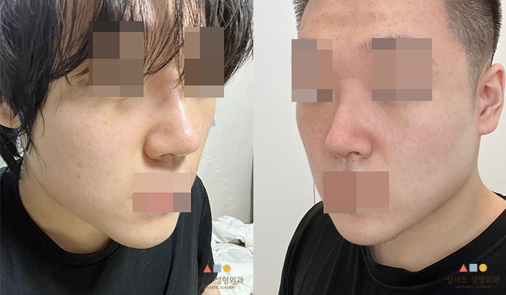 수술 후