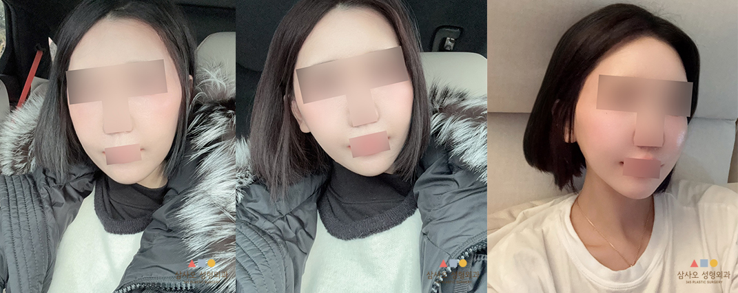 수술 후