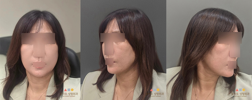수술 후