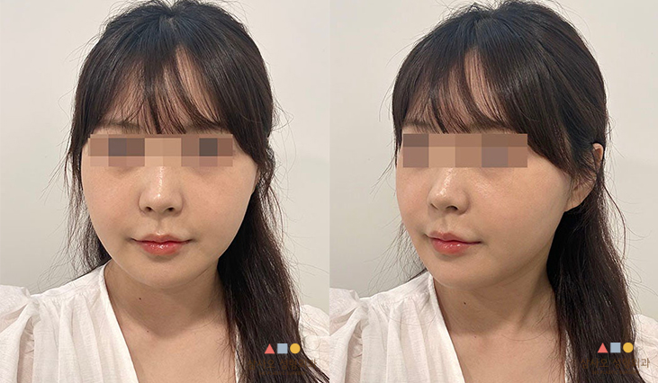 수술 후