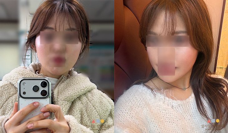 수술 2주차