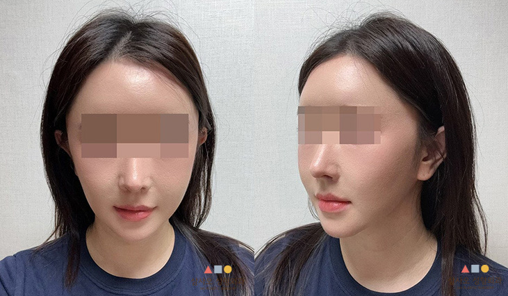 수술 후