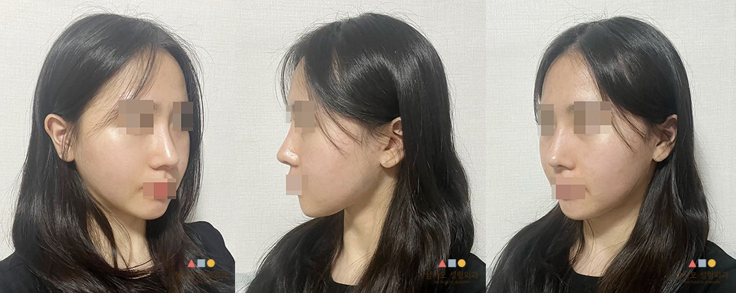 수술 후