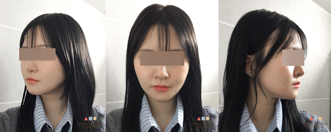 수술 후