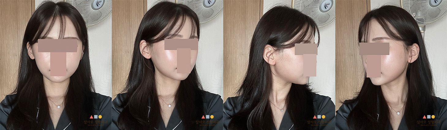 수술 후