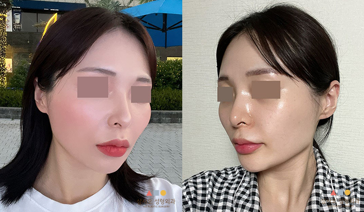 수술 전
