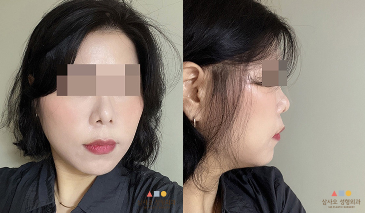 수술 후