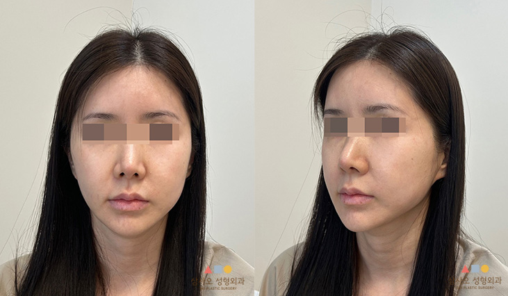 수술 전