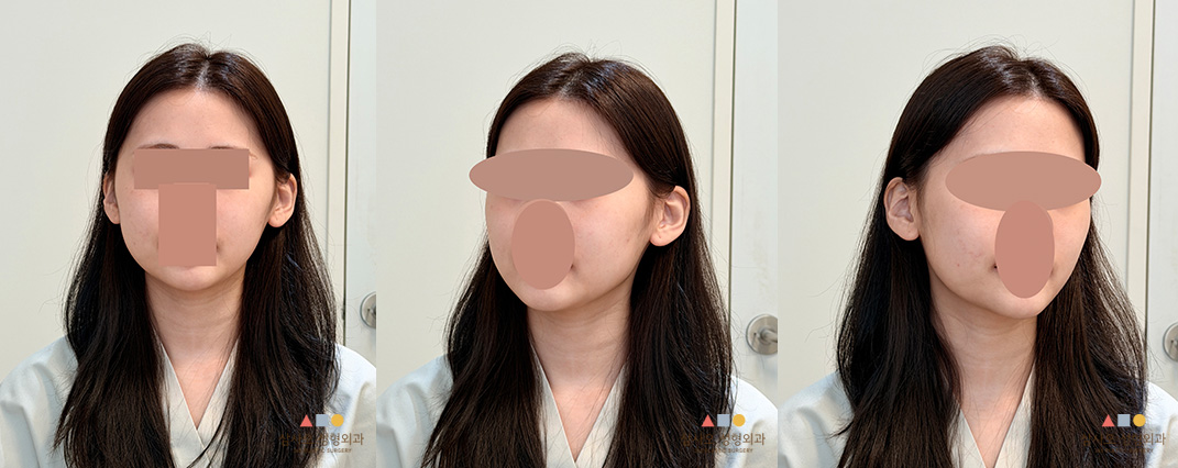 수술 전