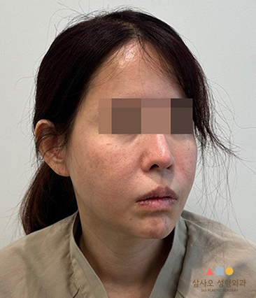 수술 전