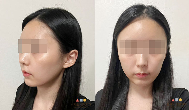 수술 후