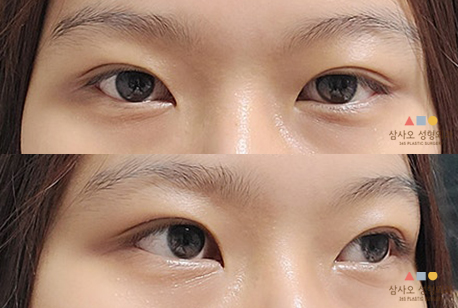 수술 후