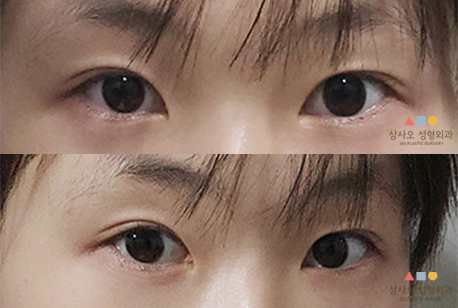 수술 후