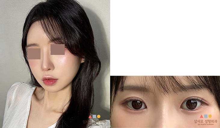 수술 후