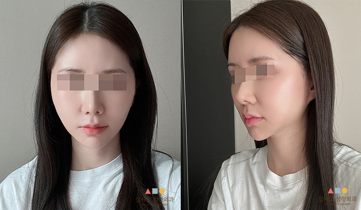 수술 후