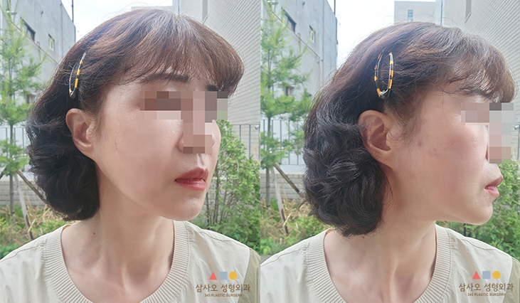 수술 후