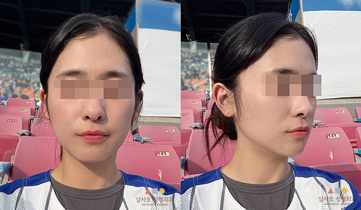 수술 후