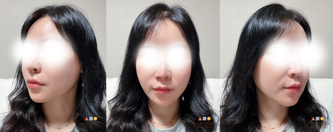 수술 후