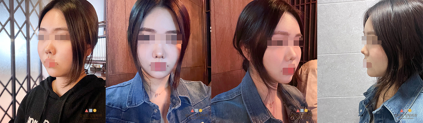 수술 후