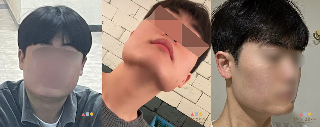 수술 전