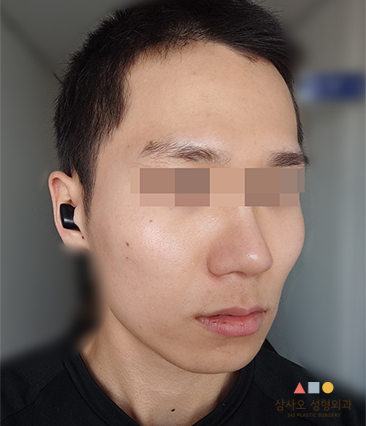 수술 전