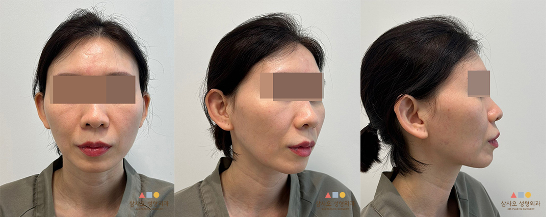 수술 전