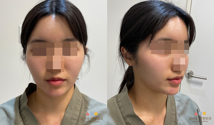 수술 전