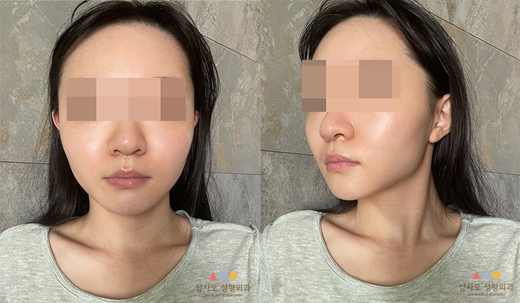 수술 전