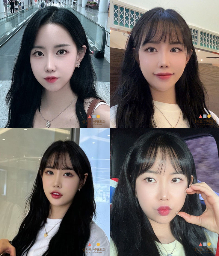 수술 후