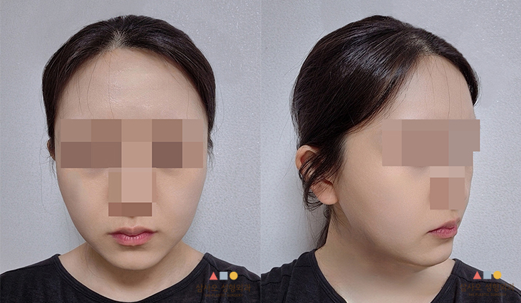 수술 후
