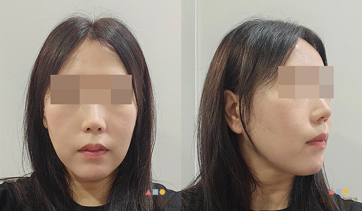수술 후