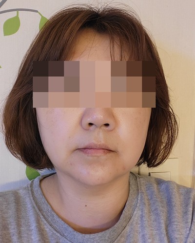 수술 후