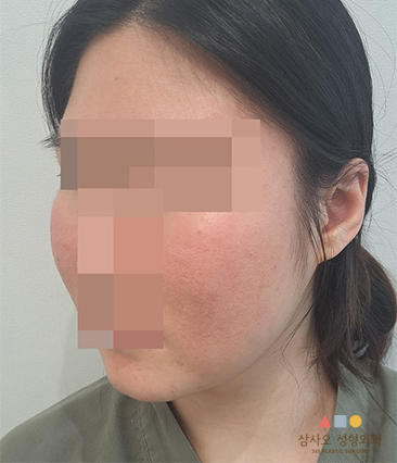 수술 전