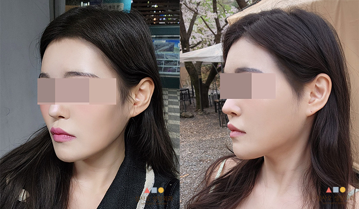 수술 후