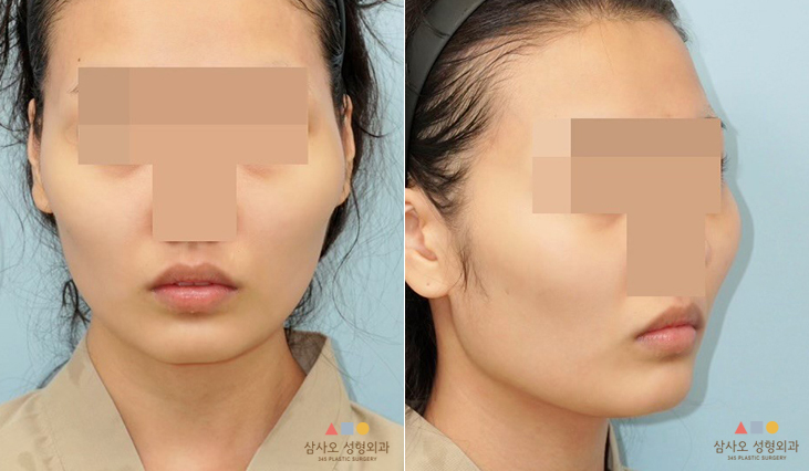 수술 전